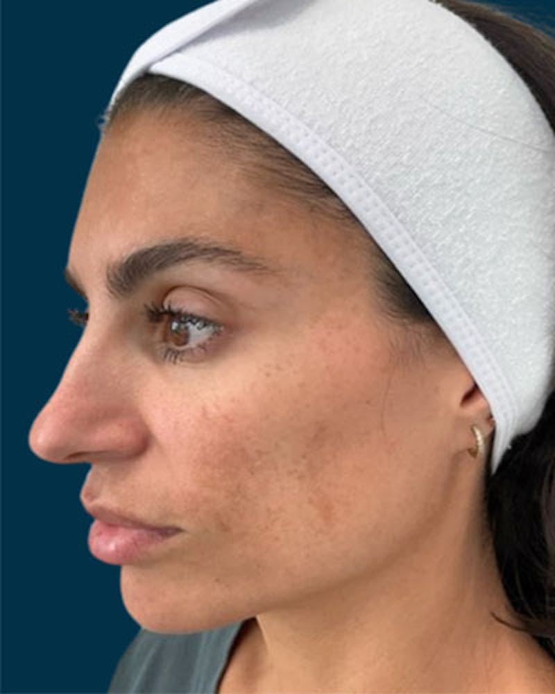 Cosmelan Peel Before & After Gallery - Patient 242579 - Image 5