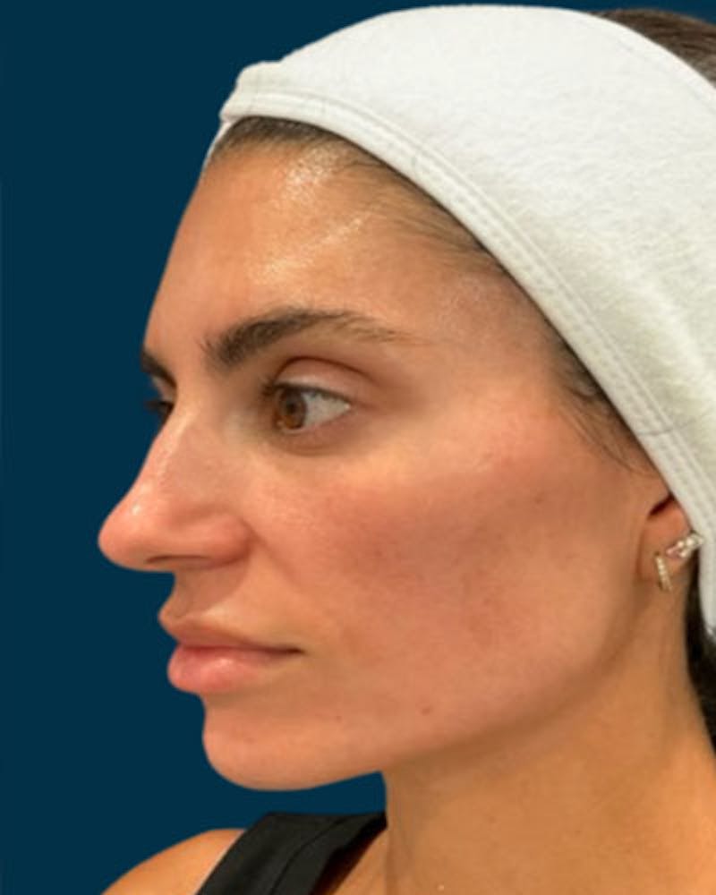 Cosmelan Peel Before & After Gallery - Patient 242579 - Image 6