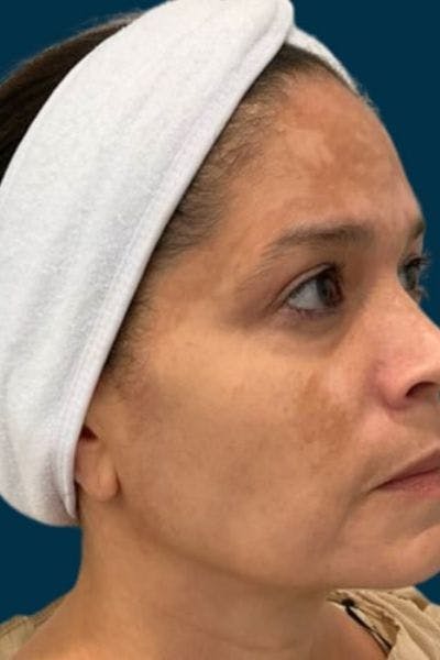 Cosmelan Peel Before & After Gallery - Patient 359231 - Image 1