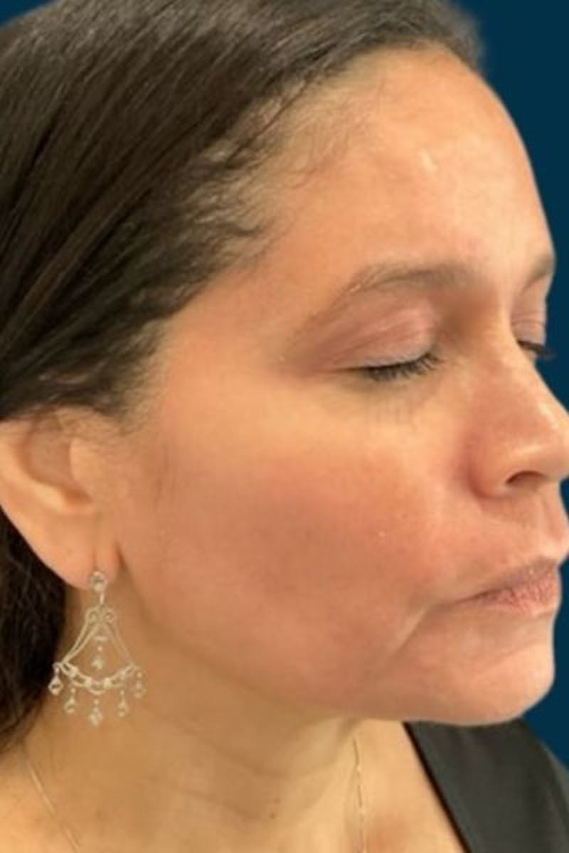 Cosmelan Peel Before & After Gallery - Patient 359231 - Image 2