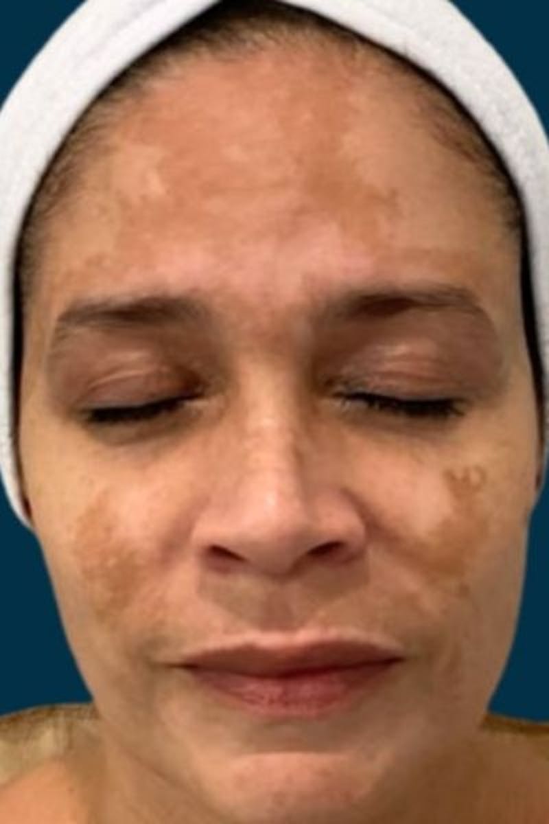 Cosmelan Peel Before & After Gallery - Patient 359231 - Image 3