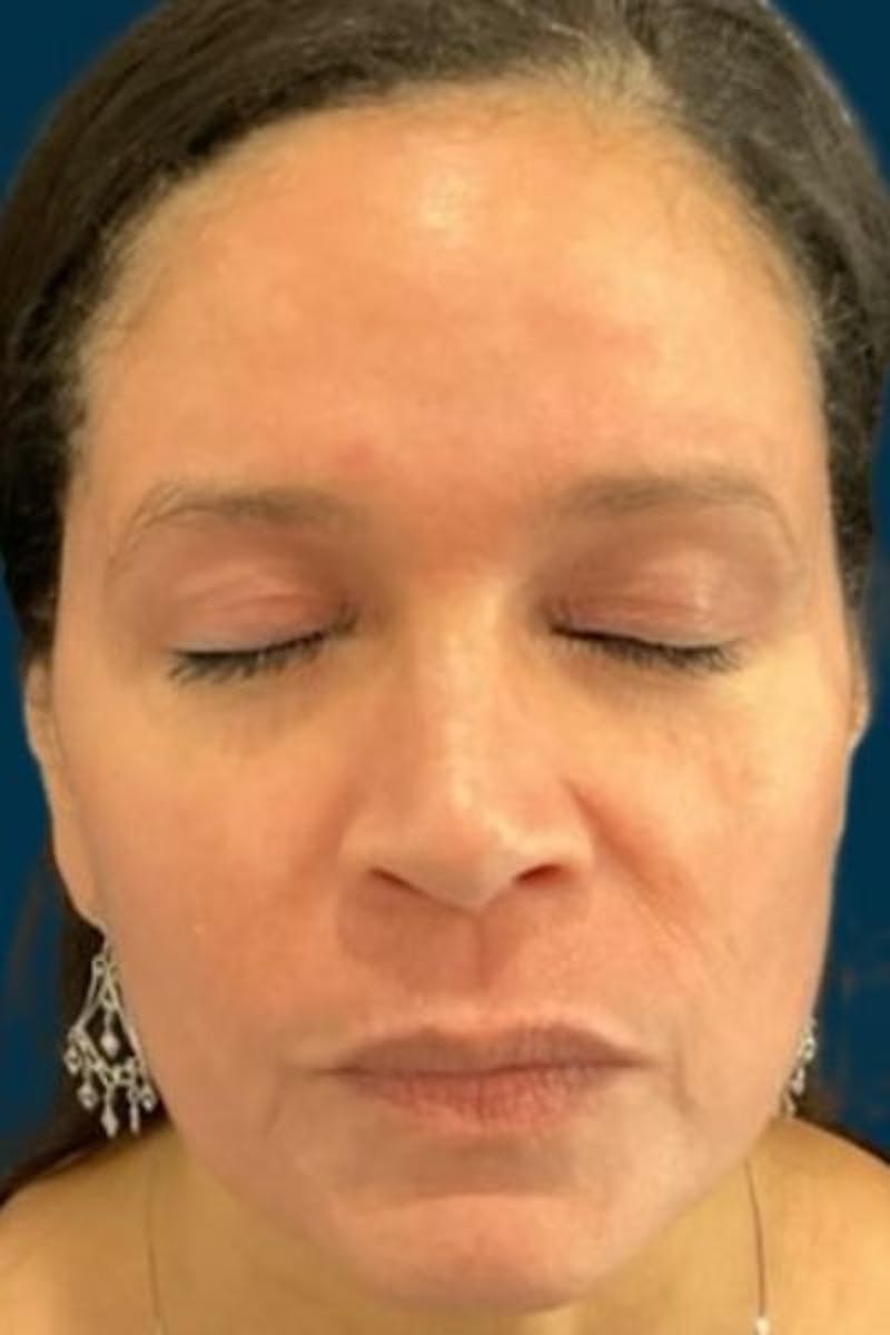 Cosmelan Peel Before & After Gallery - Patient 359231 - Image 4