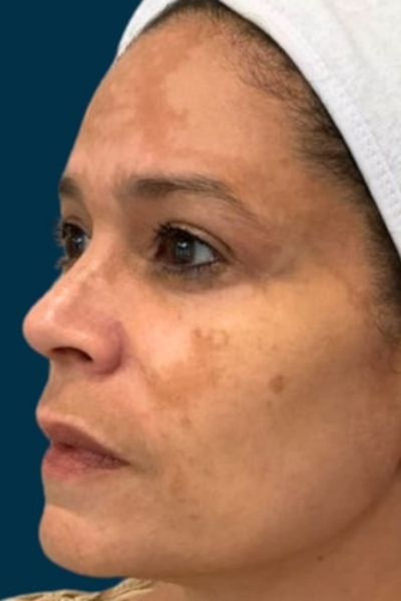 Cosmelan Peel Before & After Gallery - Patient 359231 - Image 5