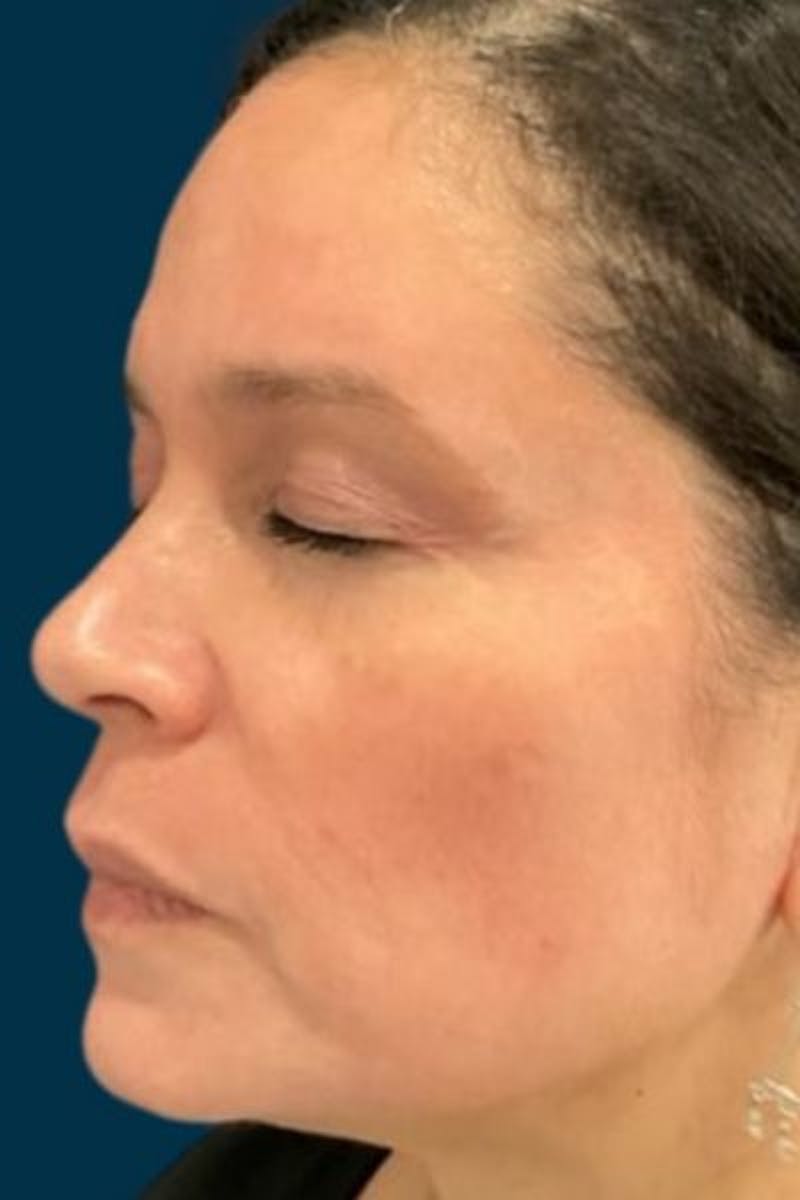 Cosmelan Peel Before & After Gallery - Patient 359231 - Image 6