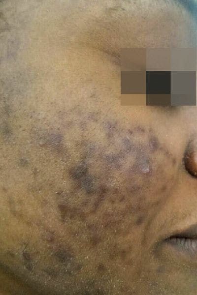 Cosmelan Peel Before & After Gallery - Patient 214556 - Image 1