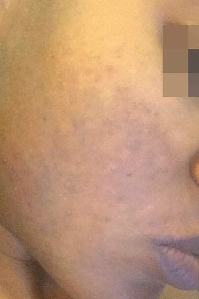 Cosmelan Peel Before & After Gallery - Patient 214556 - Image 2