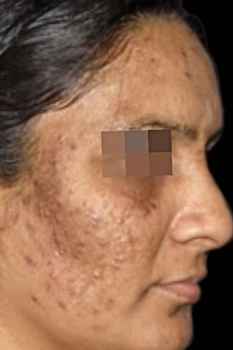 Cosmelan Peel Before & After Gallery - Patient 322025 - Image 1