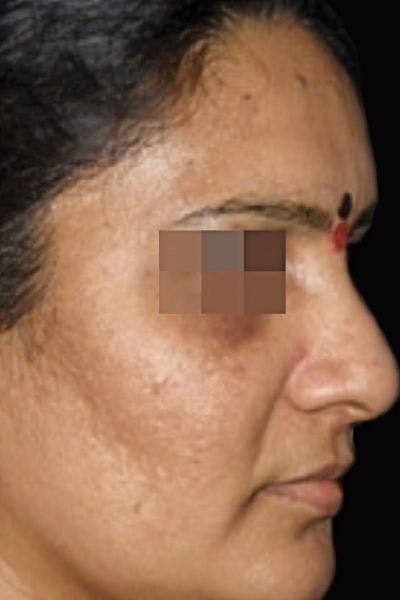 Cosmelan Peel Before & After Gallery - Patient 322025 - Image 2