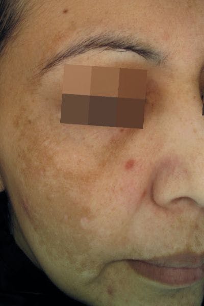 Cosmelan Peel Before & After Gallery - Patient 323366 - Image 1