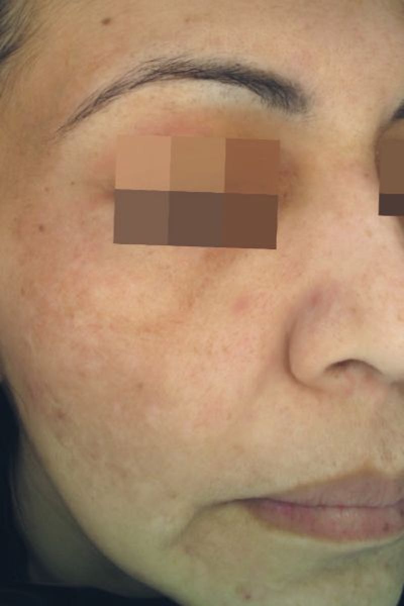 Cosmelan Peel Before & After Gallery - Patient 323366 - Image 2