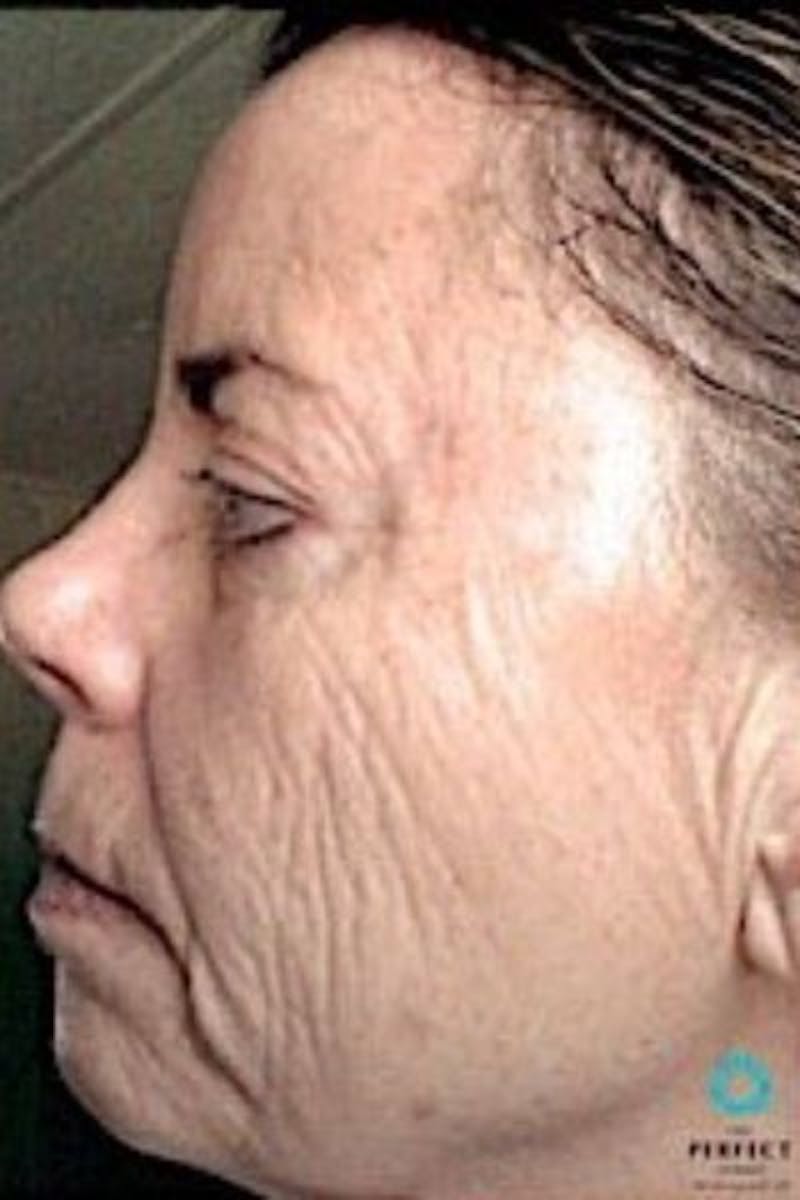 Perfect Derma Peel Before & After Gallery - Patient 273736 - Image 1