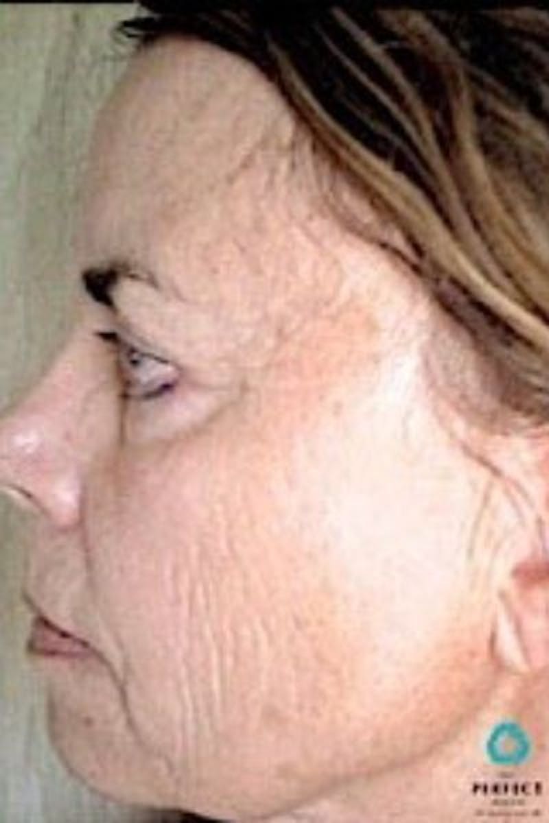 Perfect Derma Peel Before & After Gallery - Patient 273736 - Image 2
