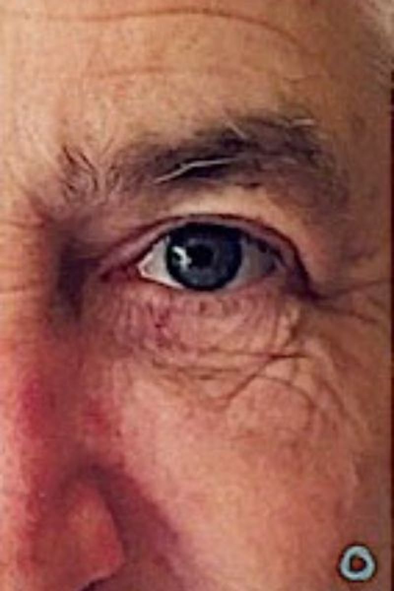 Perfect Derma Peel Before & After Gallery - Patient 374077 - Image 1