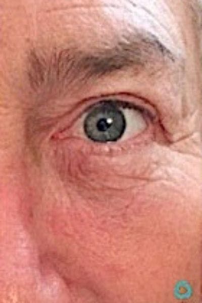Perfect Derma Peel Before & After Gallery - Patient 374077 - Image 2