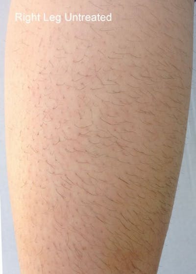 Diolaze Laser Hair Removal Before & After Gallery - Patient 708778 - Image 1