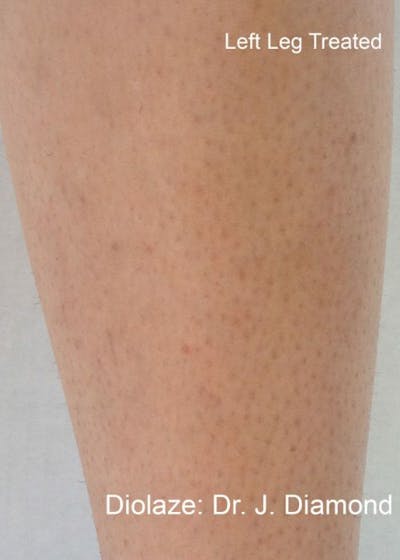 Diolaze Laser Hair Removal Before & After Gallery - Patient 708778 - Image 2