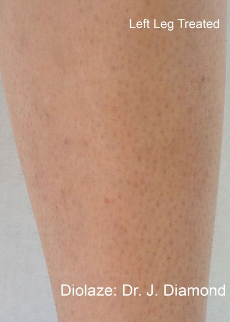Diolaze Laser Hair Removal Before & After Gallery - Patient 708778 - Image 2