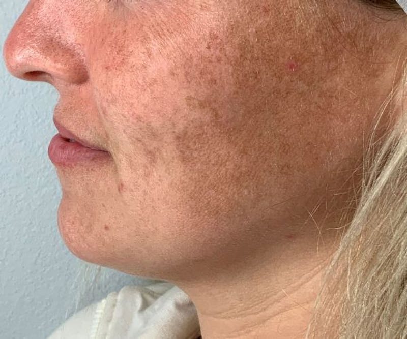 Optimas IPL Treatment Before & After Gallery - Patient 186797 - Image 1