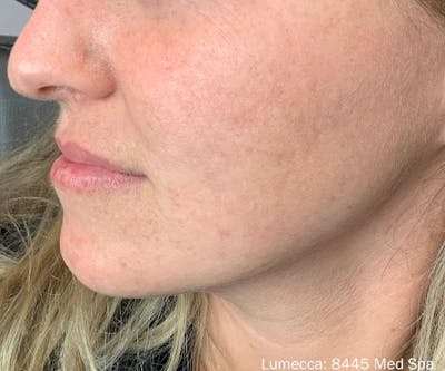 Optimas IPL Treatment Before & After Gallery - Patient 186797 - Image 2