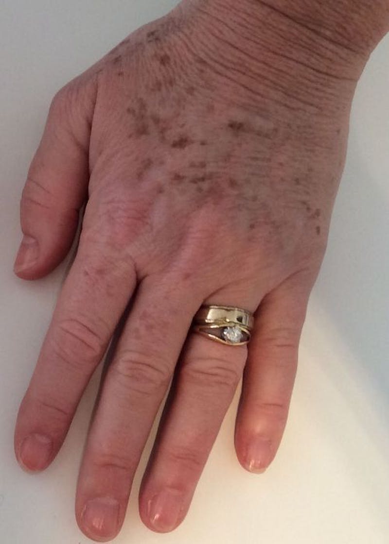 Optimas IPL Treatment Before & After Gallery - Patient 398511 - Image 1