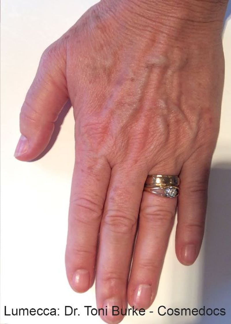 Optimas IPL Treatment Before & After Gallery - Patient 398511 - Image 2