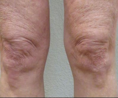 Morpheus8 Before & After Gallery - Patient 416799 - Image 1