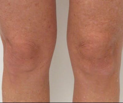 Morpheus8 Before & After Gallery - Patient 416799 - Image 2