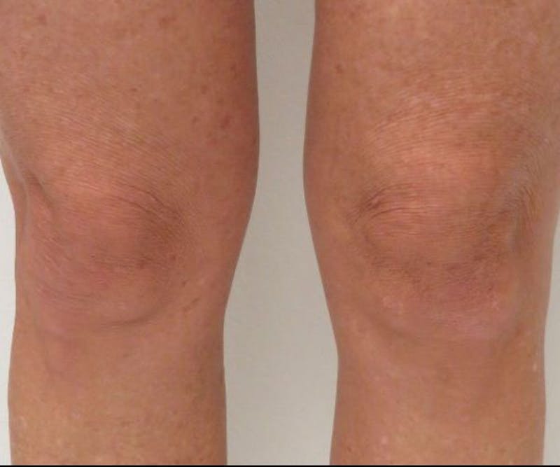 Morpheus8 Before & After Gallery - Patient 416799 - Image 2