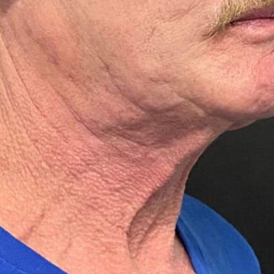 Morpheus8 Before & After Gallery - Patient 422215 - Image 1