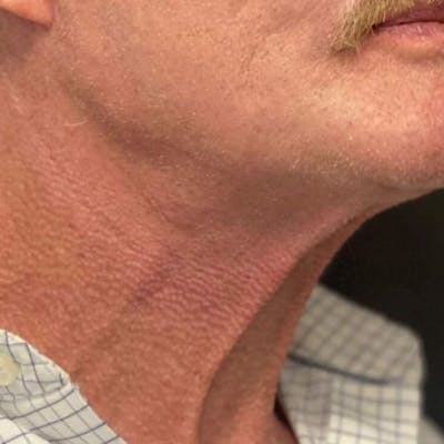 Morpheus8 Before & After Gallery - Patient 422215 - Image 2