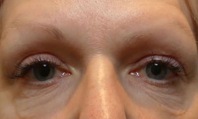 Morpheus8 Before & After Gallery - Patient 406682 - Image 1