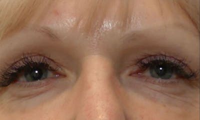 Morpheus8 Before & After Gallery - Patient 406682 - Image 2