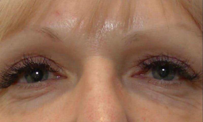 Morpheus8 Before & After Gallery - Patient 406682 - Image 2