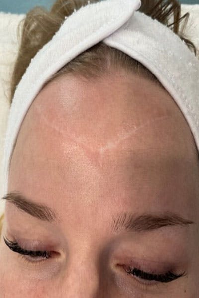 Microneedling Before & After Gallery - Patient 261045 - Image 1