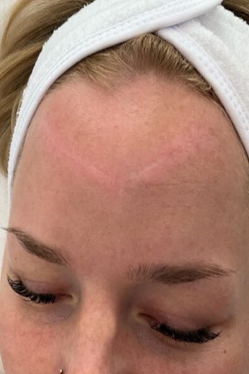 Microneedling Before & After Gallery - Patient 261045 - Image 2