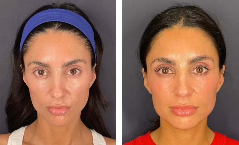 sculptra before and after