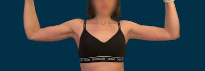 Brachioplasty (Arm Lifts) Before & After Gallery - Patient 116337 - Image 2