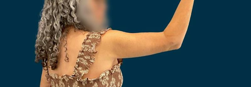 Brachioplasty (Arm Lifts) Before & After Gallery - Patient 407783 - Image 6