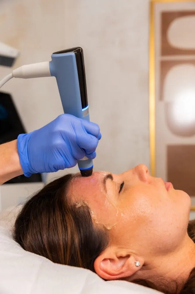 woman getting microneedling treatment