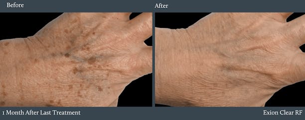 Hand Before & After Gallery - Patient 256573 - Image 1