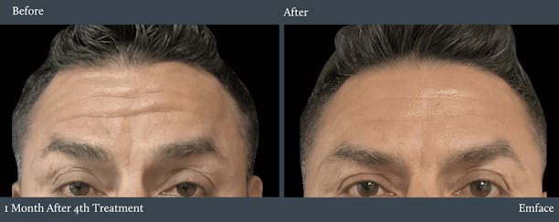 Forehead Before & After Gallery - Patient 217988 - Image 1