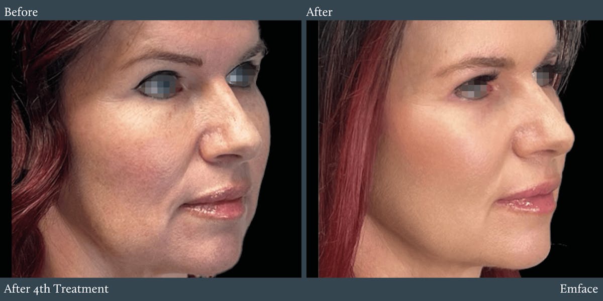 Full Face Before & After Gallery - Patient 375597 - Image 1