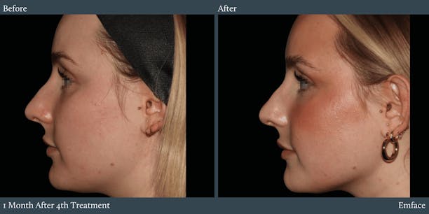 Full Face Before & After Gallery - Patient 169097 - Image 1