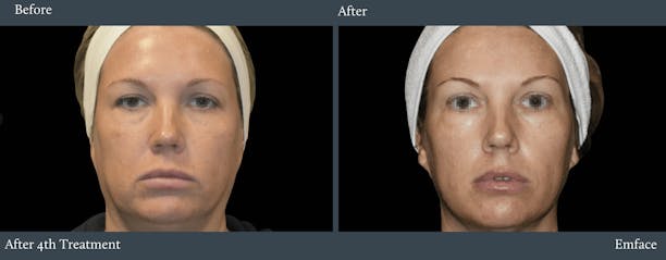 Full Face Before & After Gallery - Patient 680038 - Image 1