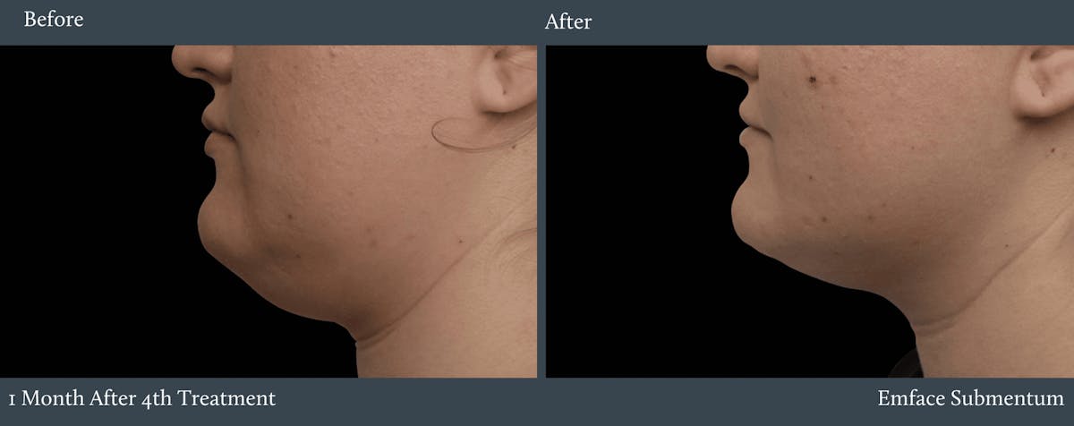 Submentum Before & After Gallery - Patient 233294 - Image 1