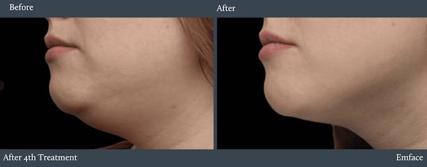 Submentum Before & After Gallery - Patient 231505 - Image 1