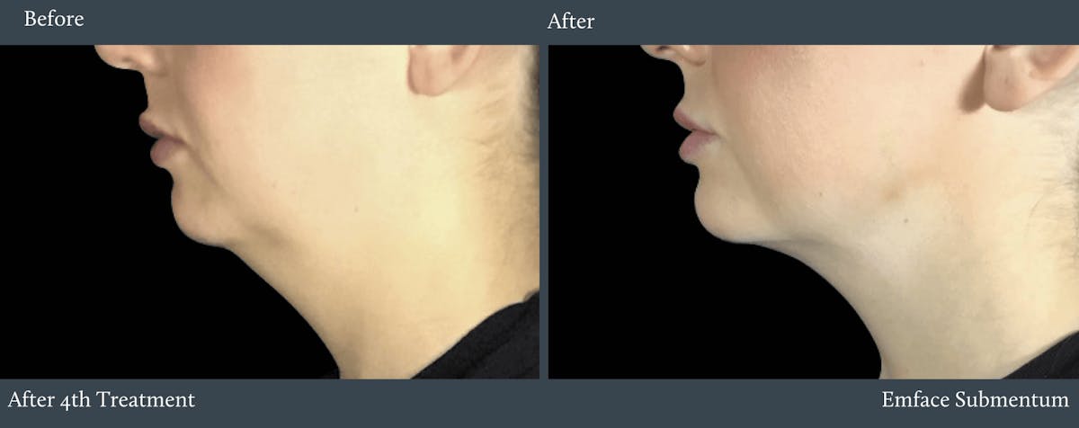 Submentum Before & After Gallery - Patient 165677 - Image 1