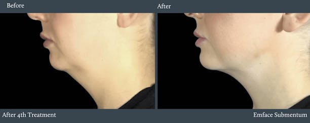 Submentum Before & After Gallery - Patient 165677 - Image 1