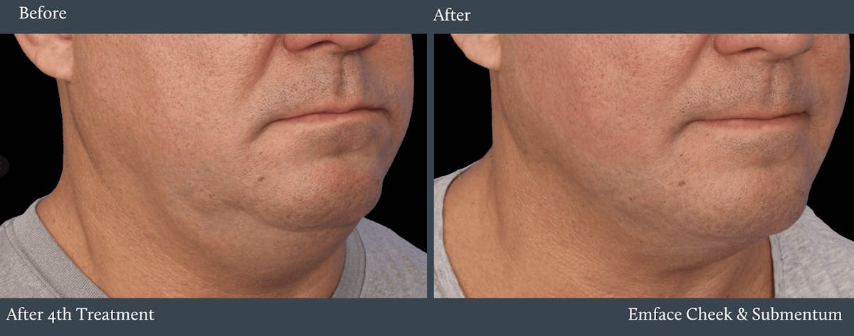 Submentum Before & After Gallery - Patient 583849 - Image 1