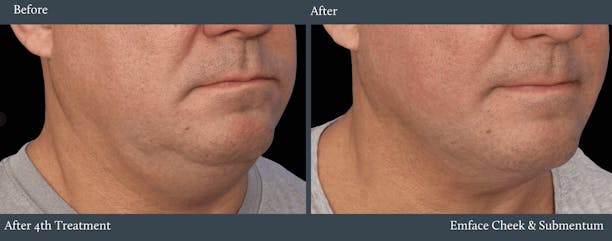 Submentum Before & After Gallery - Patient 583849 - Image 1